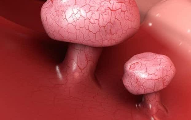 Are Colon Polyps Cancerous? 3 f64d62ac6fa22fd93a8e9828fad84452 cropped optimized